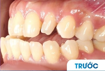 Trước khi làm răng